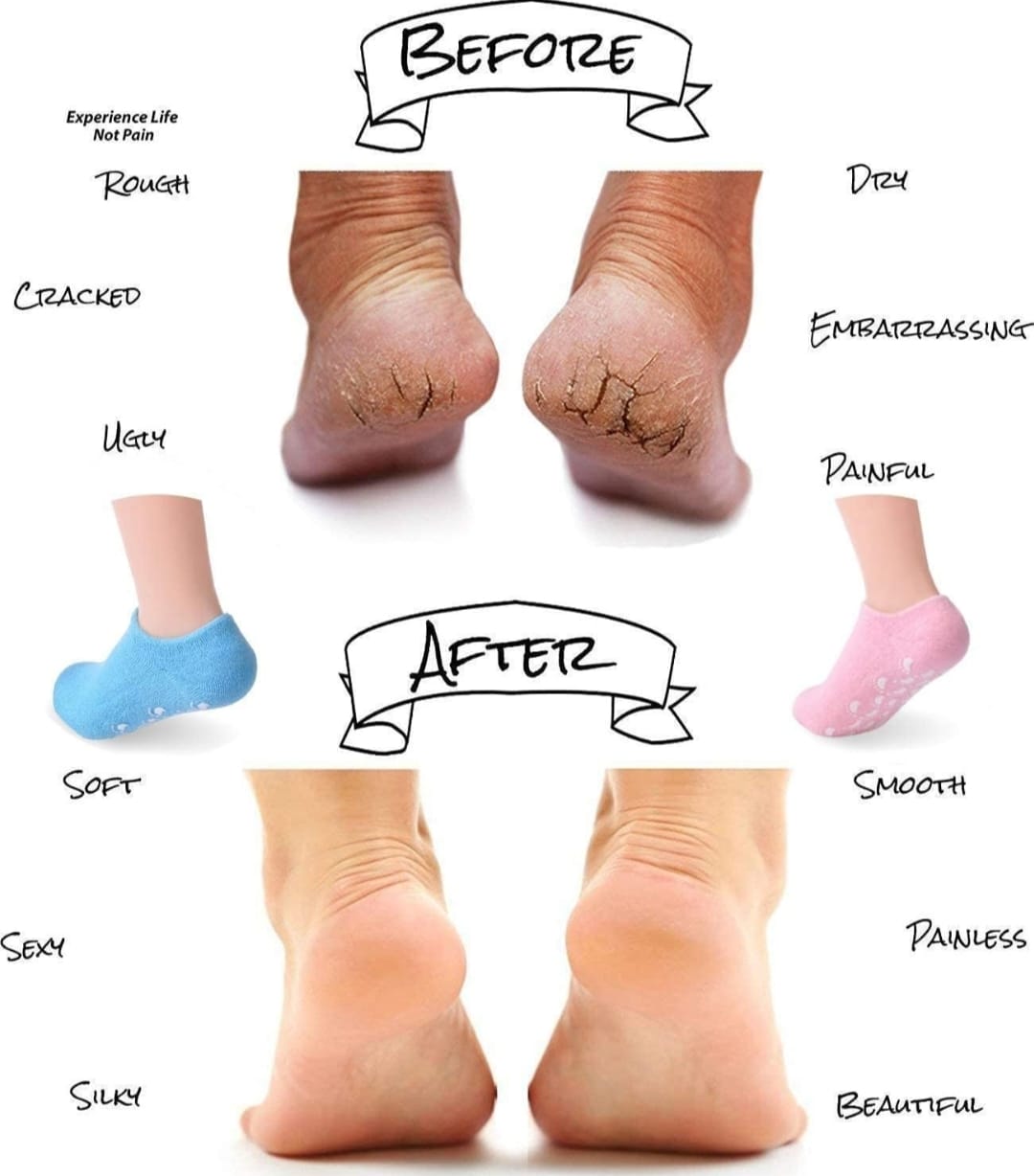 Spa Gel Socks – Moisturizing Silicone Foot Care for Cracked Heels